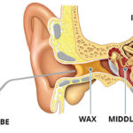Ear Microsuction