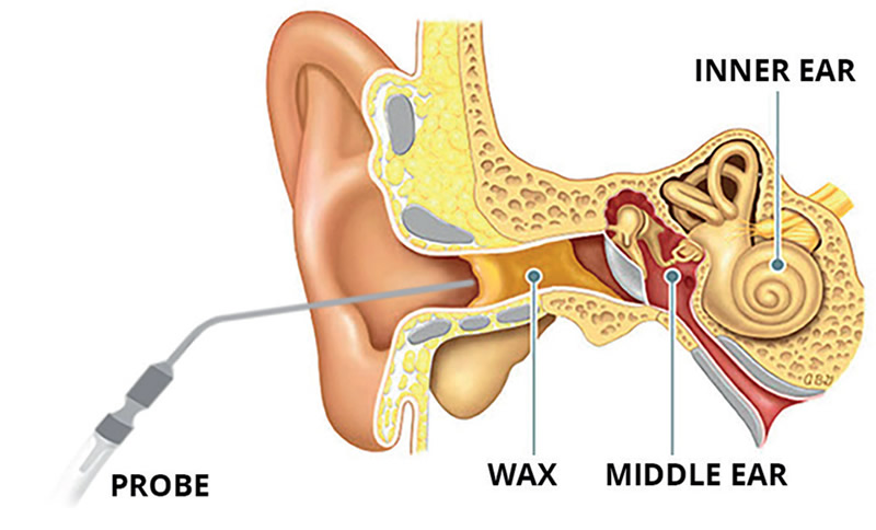 Ear Microsuction